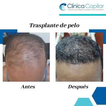 Slider image (7) Clinica Capilar